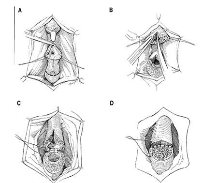 Urethroplasty in women