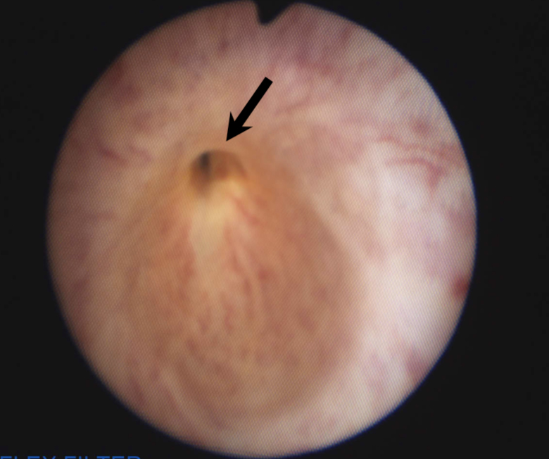 narrowing in urethra