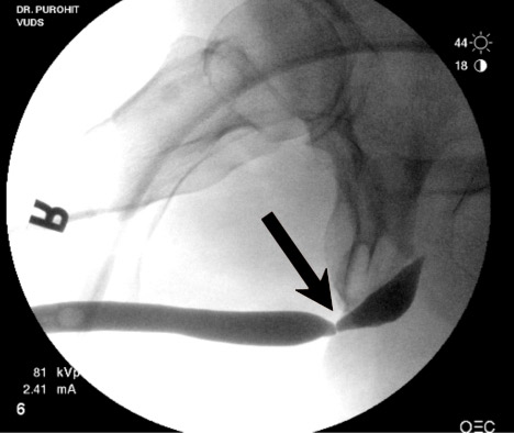 Urethral Stricture