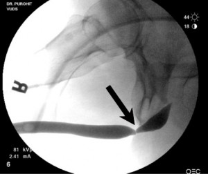 urethral-stricture2